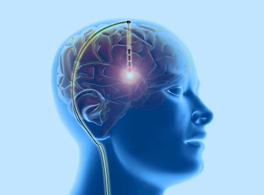 Neuromodulation Lead Placement