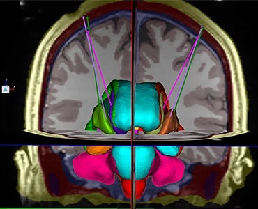 ClearPoint® Neuro Navigation System Software