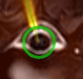 Targeted Delivery  and Tolerability of MRI-Guided CED Infusion into the Cerebellum of Nonhuman Primates