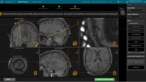 Neuro Array SmartFrame Array Neuro Navigation System - ClearPoint Neuro